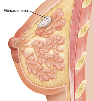 Side view cross section of breast showing fibroadenoma.