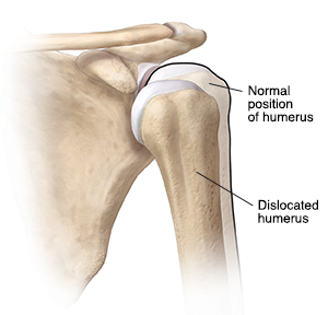 Front view of dislocated shoulder.