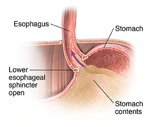 Stomach contents flowing back through open lower esophageal sphincter into esophagus.