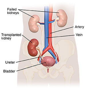 Transplanted kidney with ureter in lower belly area, showing bladder and failed kidneys.