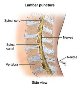 Side view cross-section of lumbar spineSide view cross-section of lumbar spine showing lumbar puncture. showing lumbar puncture.